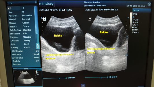 Ultraäänikuvantaminen fysioterapiassa
