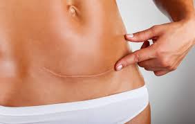 Äitiysfysioterapia sektion jälkeen